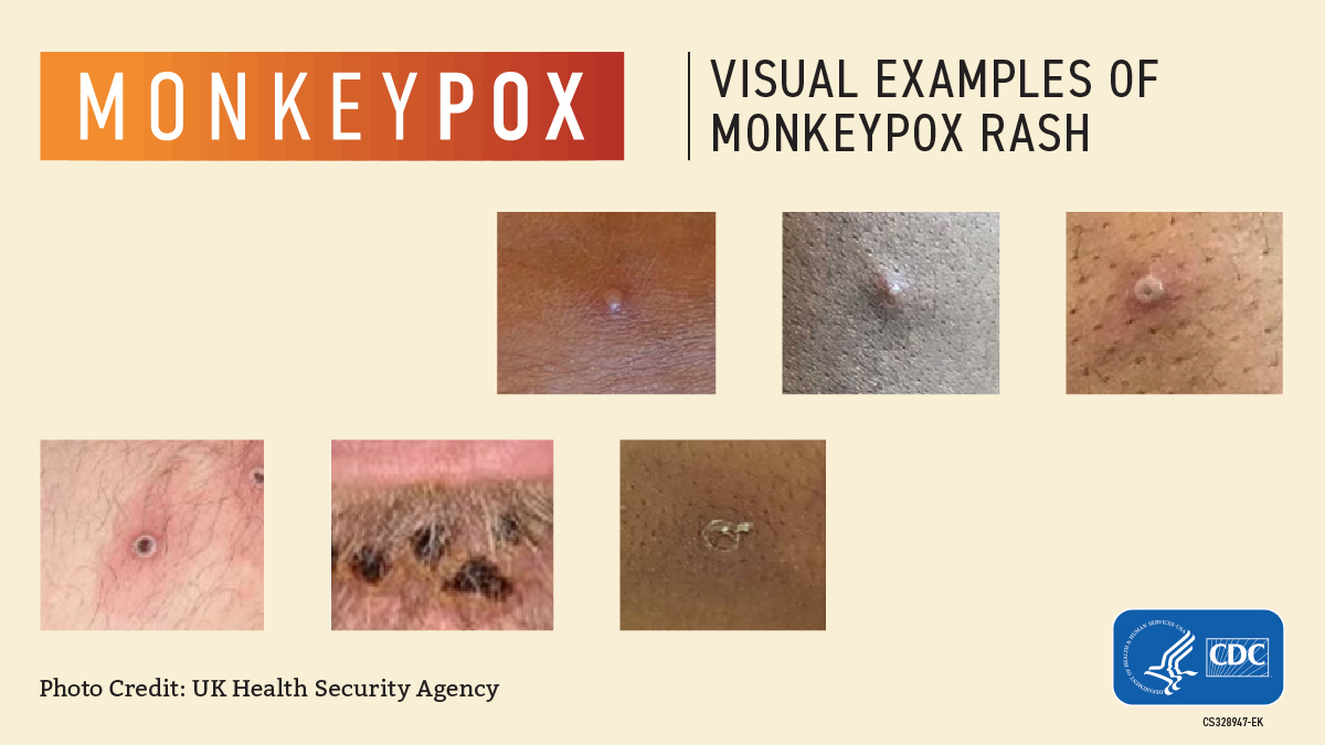 text across the top reads: "Visual examples of monkeypox rash;" below there are six close-up photos of raised pimple-like lesions on people's skin