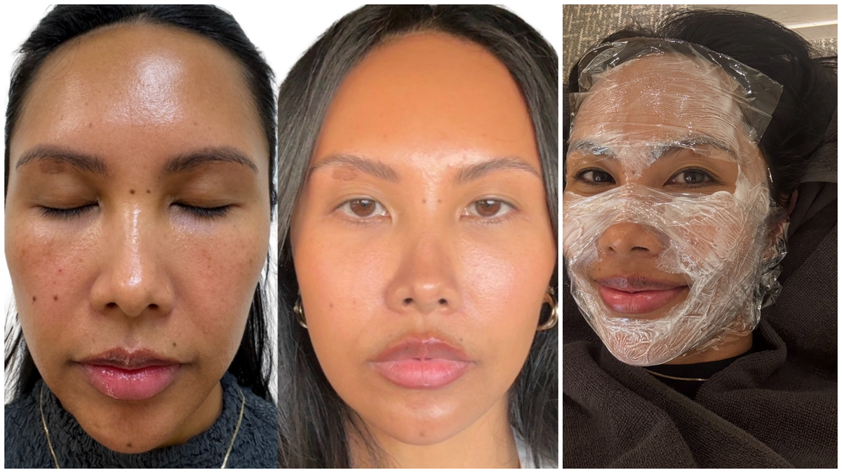 I Traveled to Korea for Salmon Sperm Injections and Was Turned Down—Meet the Under-the-Radar Laser I Tried Instead