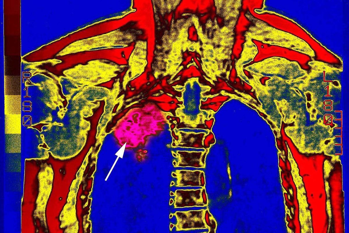 A New Lung Cancer Drug Is Shaking Up Treatment How Does