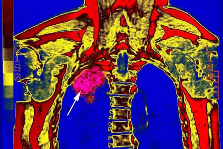 lung tumor, mri