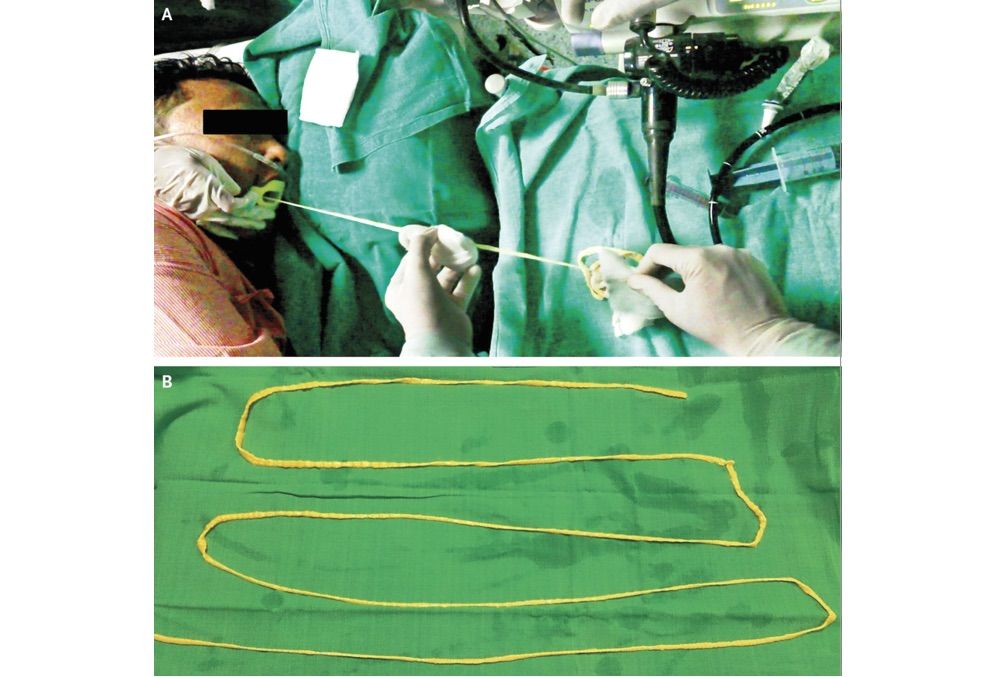 doctors-remove-6-foot-long-tapeworm-from-man-s-gut-live-science