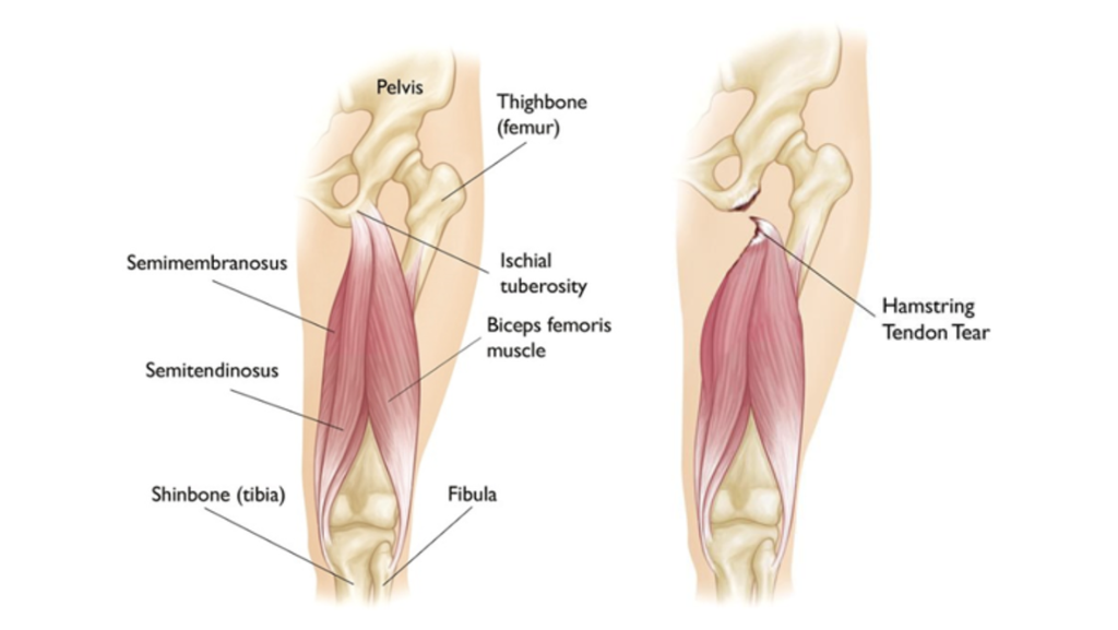Hamstring Tendons Hamstring injury in football: Recovery time, symptoms, diagnosis and ...