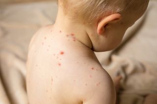 chicken pox in kids