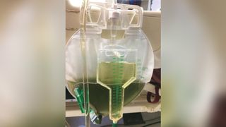 A man's urine turned green after five days in the ICU. Above, an image of the urine collected in a catheter bag.