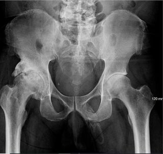 A man was diagnosed with penile ossification, a rare condition in which bone forms inside the penis. Above, the man's X-ray showing calcified tissue in the expected area of the penis.