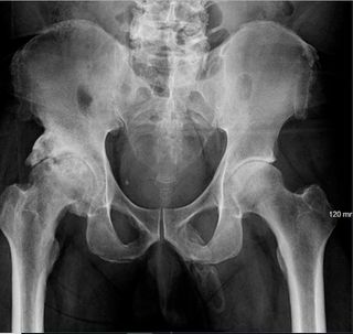 320px x 303px - Man's X-Ray Reveals His Penis Is Turning to Bone | Live Science