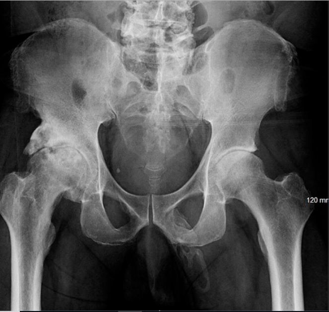 A man was diagnosed with penile ossification, a rare condition in which bone forms inside the penis. Above, the man&#039;s X-ray showing calcified tissue in the expected area of the penis.