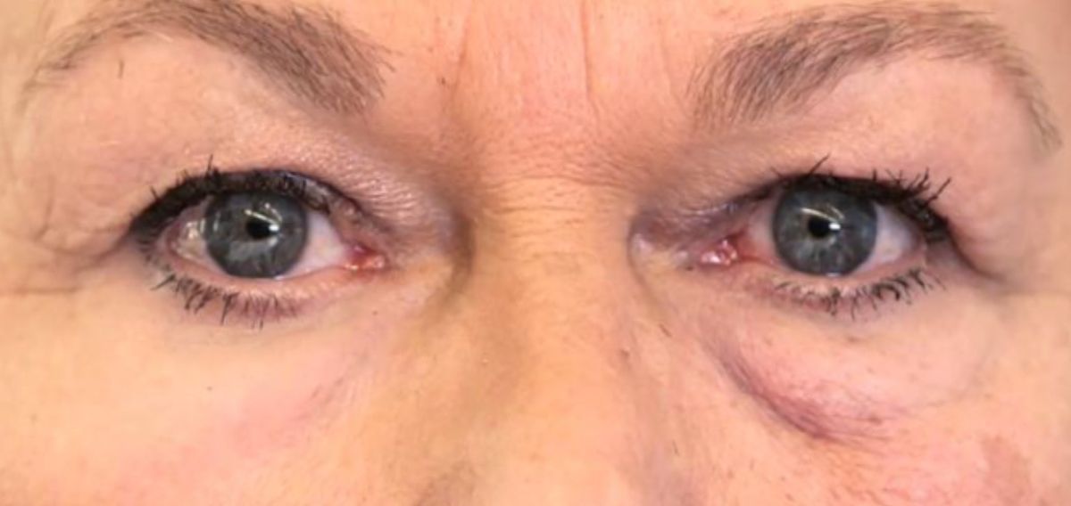 This image shows the effect of the second skin on a person&#039;s under-eye bags.