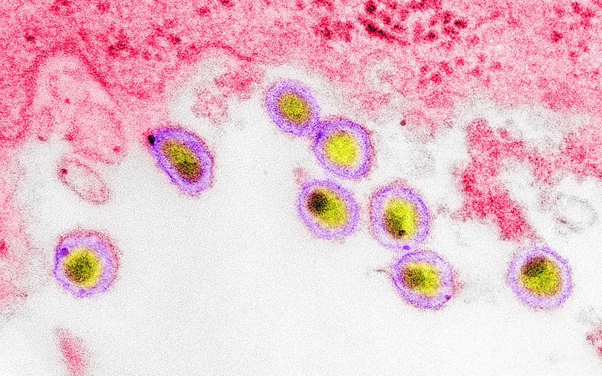 Transmission electron micrograph of HIV-1