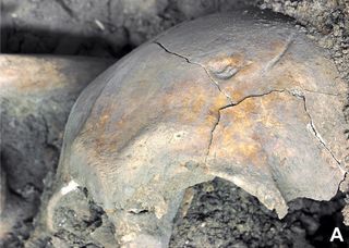 The researchers found that the soldiers had a lot of healing and healed injuries, like the head wounds seen on this skull, suggesting that many of the men had already been involved in violent encounters before this battle.