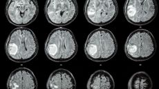 CT scans against a black background show a bright white mass in a person's brain