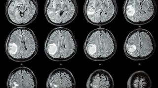 CT scans against a black background show a bright white mass in a person's brain