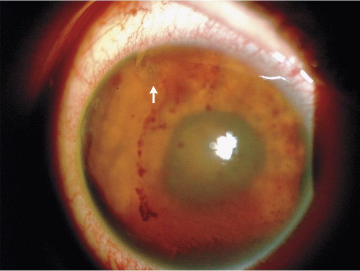 trematode, eye, case report