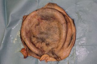 An image of the woman's scalp after the injury took place. The woman's eyebrows are visible to the left of image and the top of her right ear is visible at the bottom of the image.
