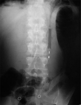 An X-ray showing a lighter that a man in Croatia swallowed.