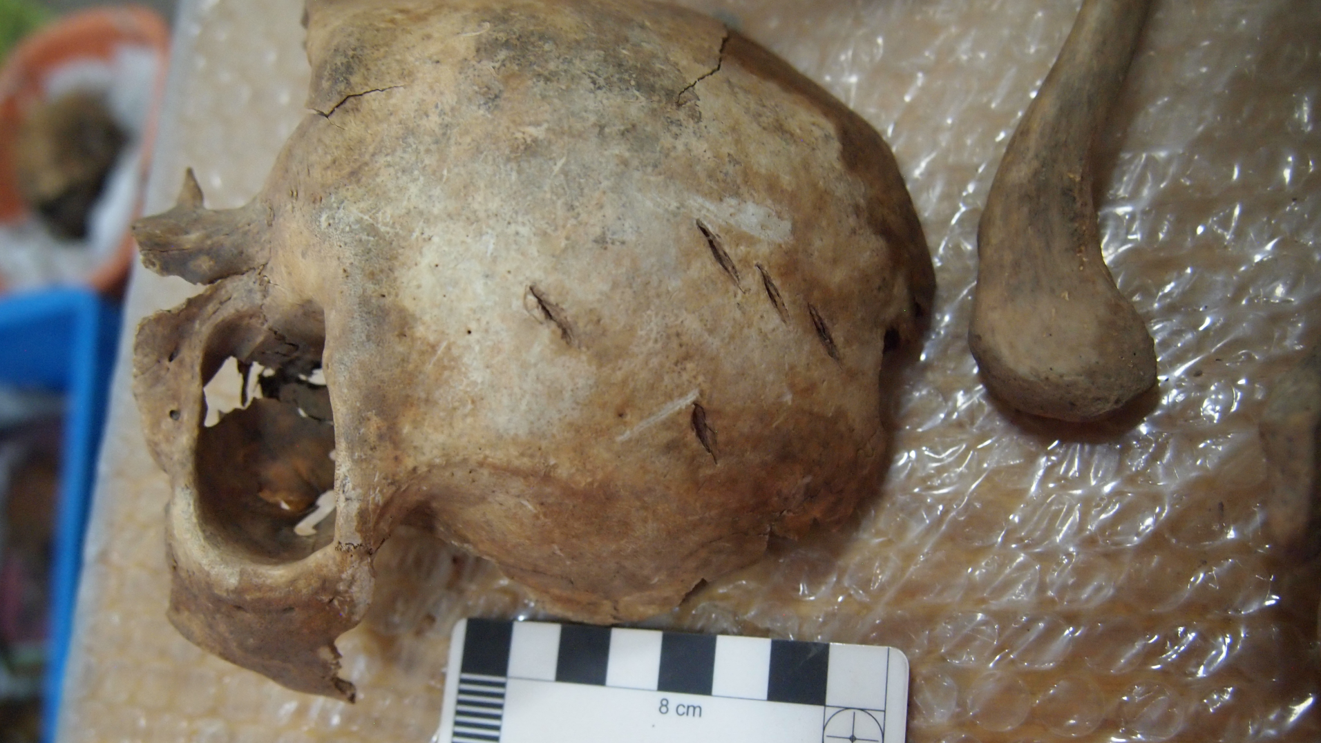 Front of a human skull showing multiple perimortem stab wounds