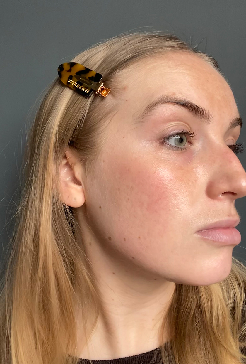 Sophie before using The Light Salon LED Mask