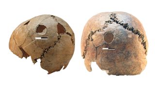 Blunt force cranial injuries that occurred at or near the time of death in two individuals from Potočani: (left) a boy age 11 to 17 years old, and (right) a young adult female.