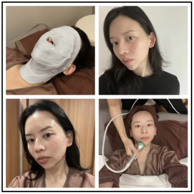 I Got 700 Salmon Sperm Injections for Brighter, Smoother Skin