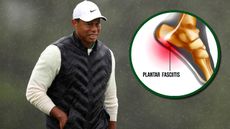 What is Plantar Fasciitis? The injury that caused Tiger Woods to withdraw from the Masters