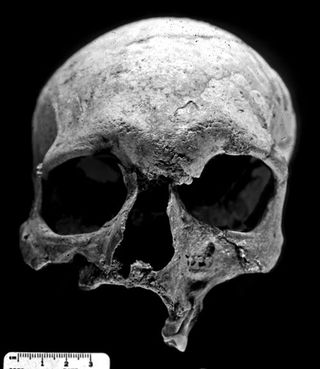 The skull of the 4,000-year-old leper skeleton found buried in Rajasthan, India. The skeleton was interred within a large stone enclosure that had been filled with vitrified ash, considered purifying in Vedic tradition.