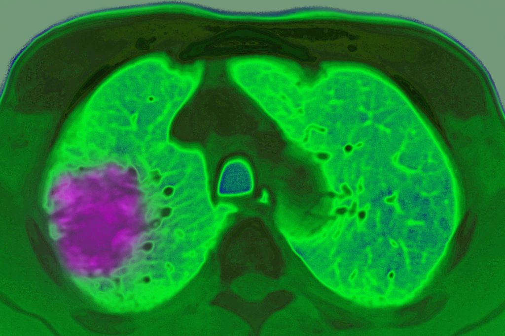 A cancer diagnosis of lung cancer, showing up in an axial plane chest MRI scan.