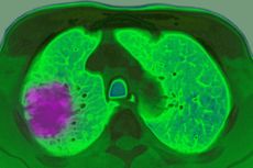A cancer diagnosis of lung cancer, showing up in an axial plane chest MRI scan.