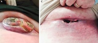 A woman with melanoma developed a large tumor on her abdomen (A), but after one combination treatment of two immunotherapy drugs, it disappeared (C) within three weeks.