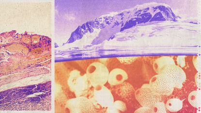 Photo collage of a micrograph of melanoma, an Antarctic iceberg, and sea squirts under water