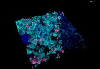 Human breast cancer bone metastasis showing the newly discovered organelle (magenta) in cancer cells (cyan).