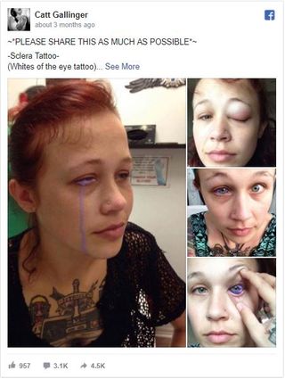 eyeball tattoo, strange medical cases