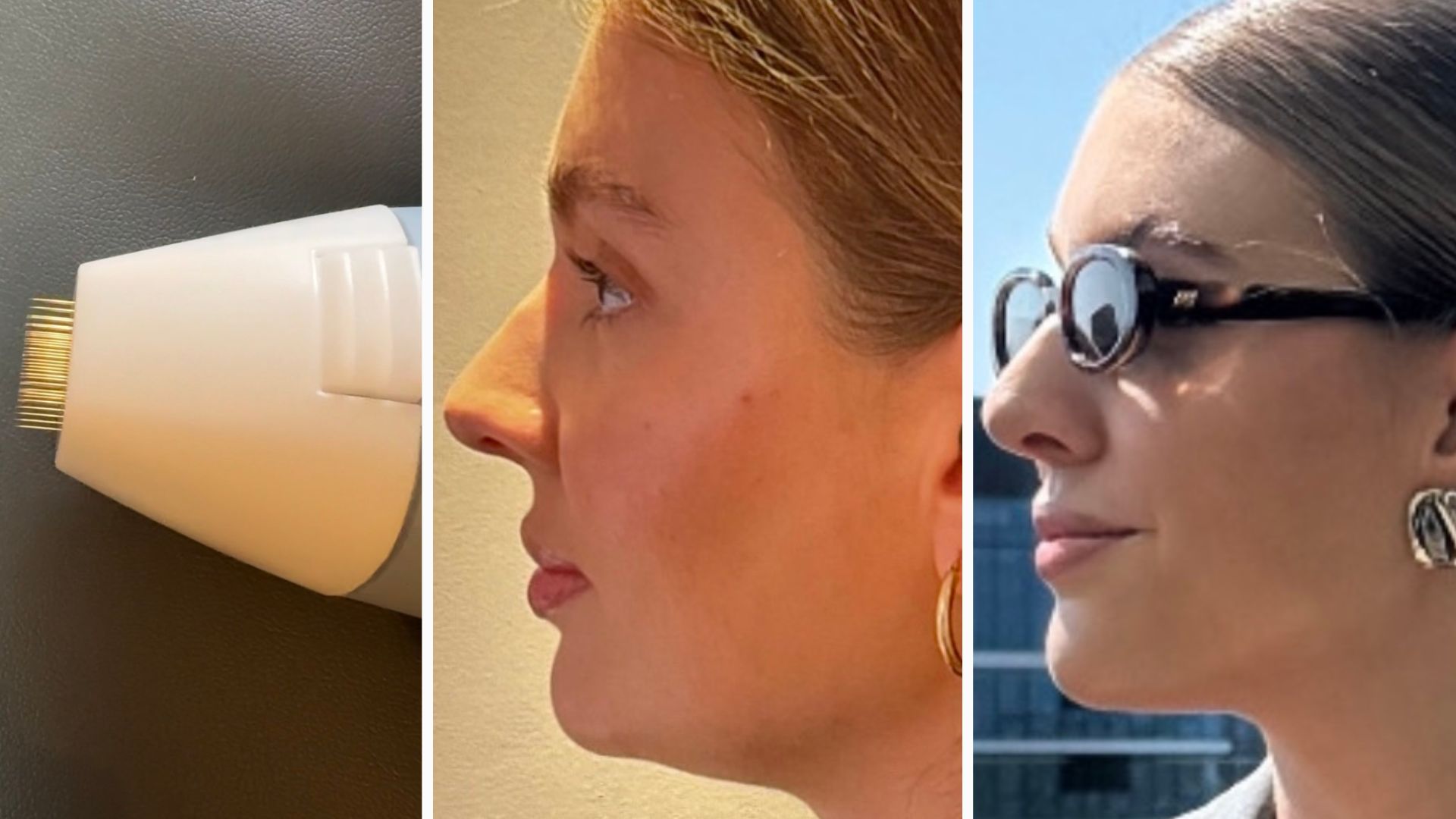 beauty editor rebecca fearn pictured before Exion treatment and after, with a more defined jawline