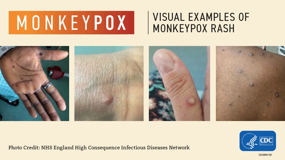 a graphic that reads "visual examples of monkeypox rash" across the top; four close-up images of monkeypox rashes are shown on people's hands, backs and ankles