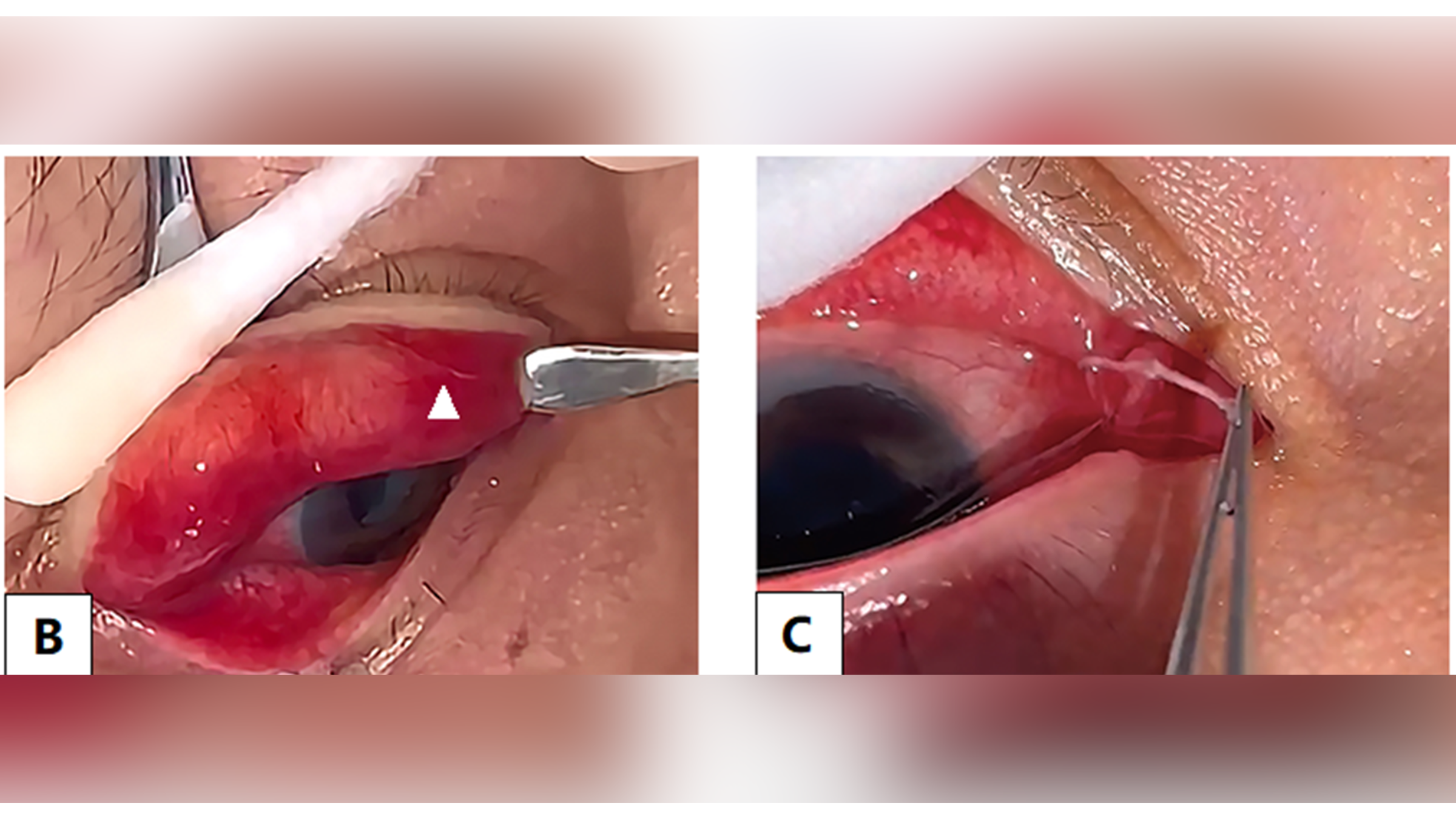 Composite image showing two images of the worms in the patients' eye that are in focus and are side by side in the center. Behind them is a blowed-up version of the images that is blurred.