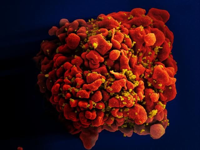 Oldest 'nearly complete' HIV genome found in forgotten tissue sample from 1966
