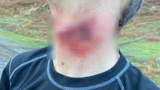 A man's slashed throat with the graphic injury blurred