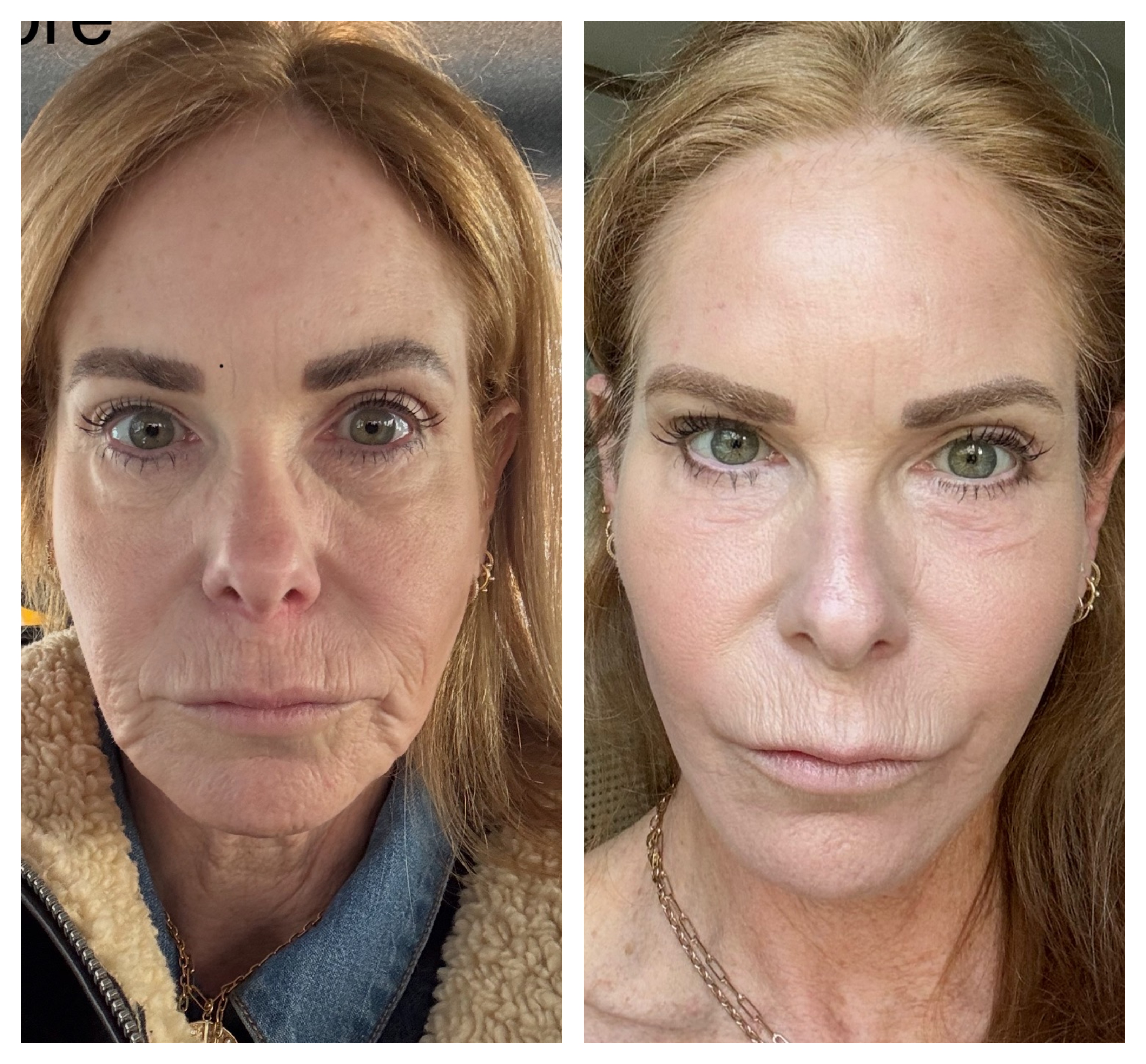 woman before and after getting a facelift side by side facing the camera