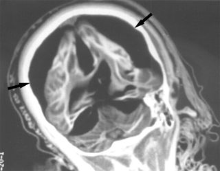 Brain scan of child mummy