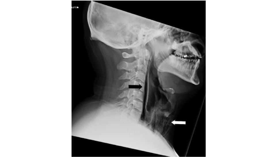 bmj, sneeze, rupture, throat, xray