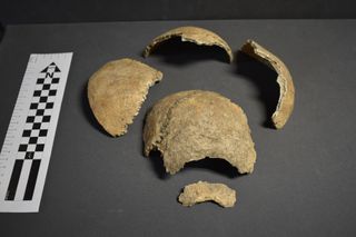 Fragments of one of the human skulls recovered from the yard of a house in Aberdeen, showing the breakages caused by a post-mortem craniotomy – the removal of the brain after death.