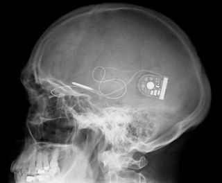 A wire trails from inside the eye to its edge and then under the skin to a point behind the ear (shown here in this X-ray image), where patients can place a control box to wirelessly supply power. Patients can also use the control box to adjust the brightness and contrast of images.