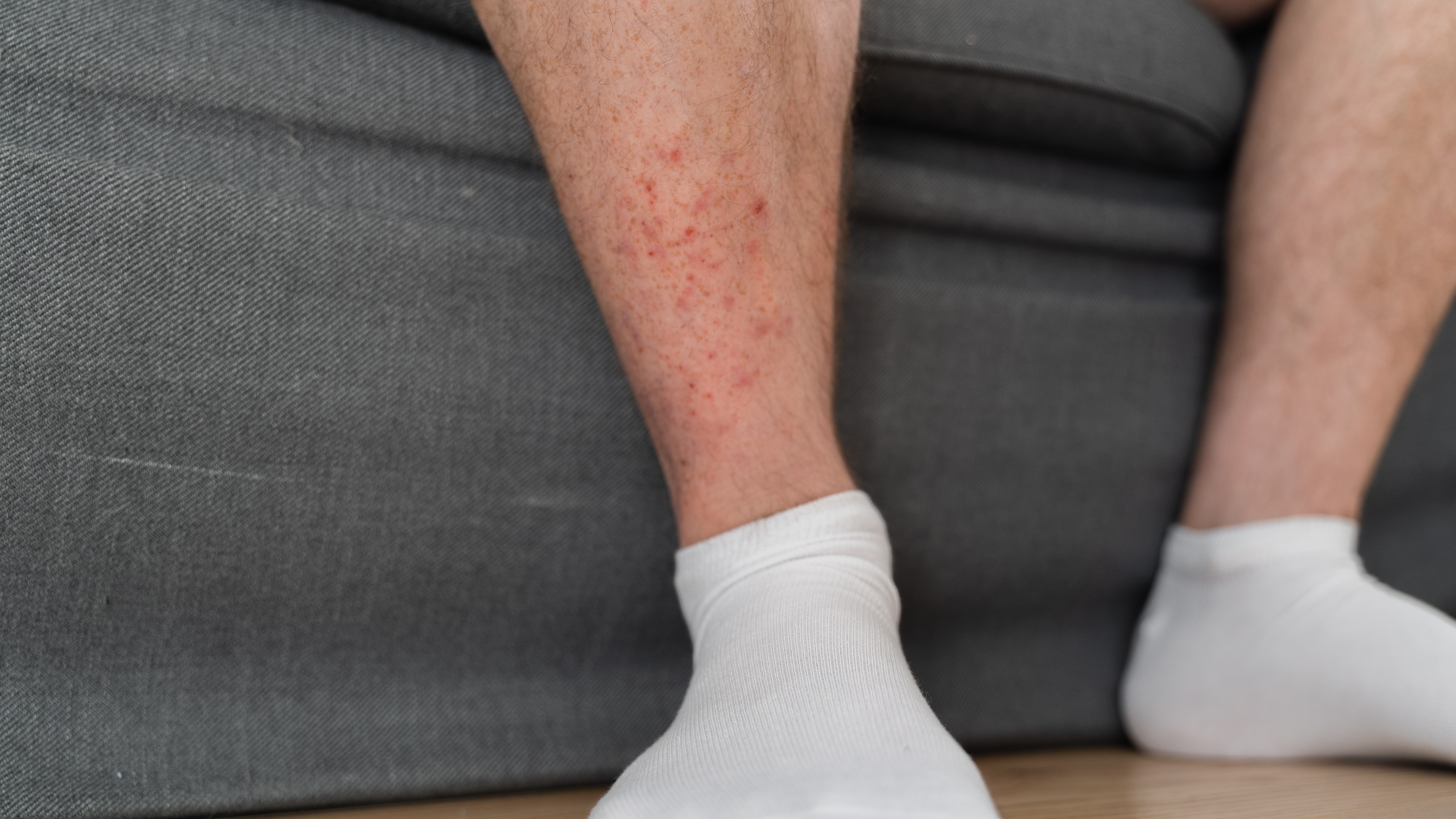 Hiker's legs with rash