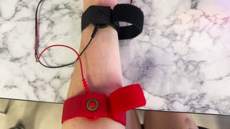 a photo of a sweat test being done, with two electrodes on a forearm