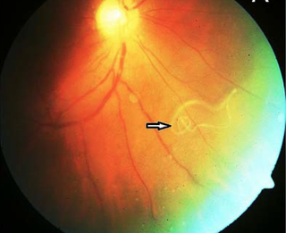 An image of the Loa loa worm in the man's eye