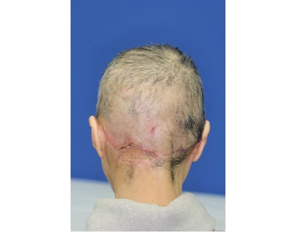 scalp, bmj