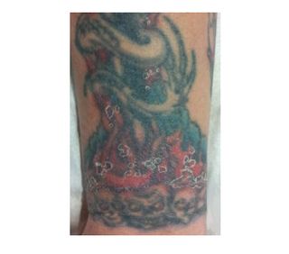In this image of the patient's tattoo, skin lesions as a result of delayed reaction to red ink have healed, leaving peeling skin behind.