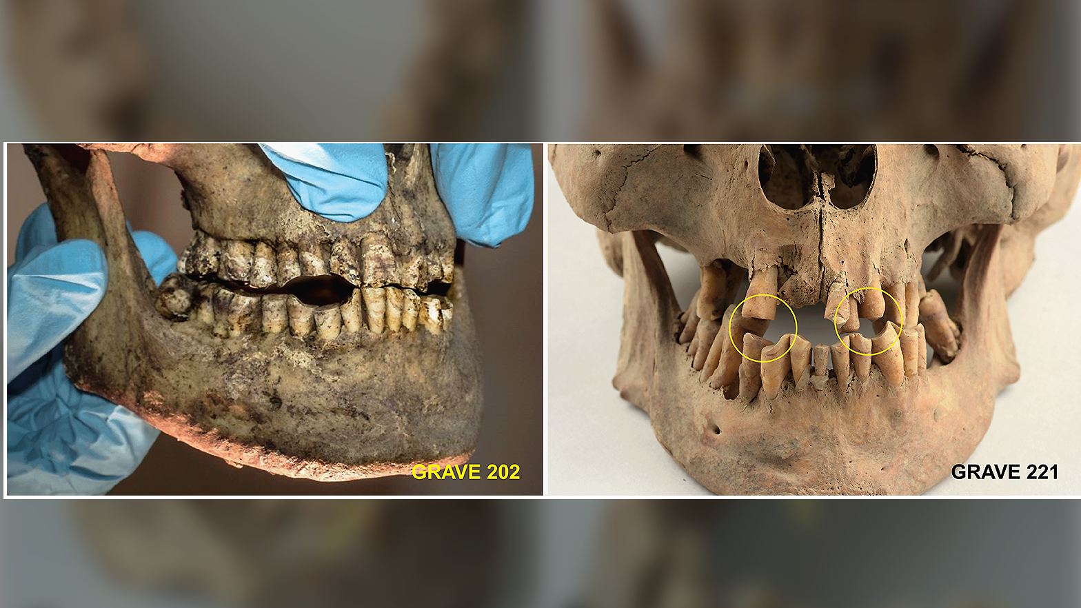 side and front view of two skulls whose teeth have circular facets indicating pipe smoking