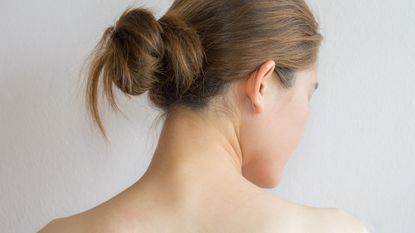 woman with neck acne 