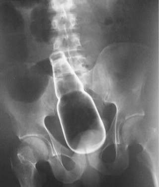 An x-ray reveals a beer bottle inside a man's colon