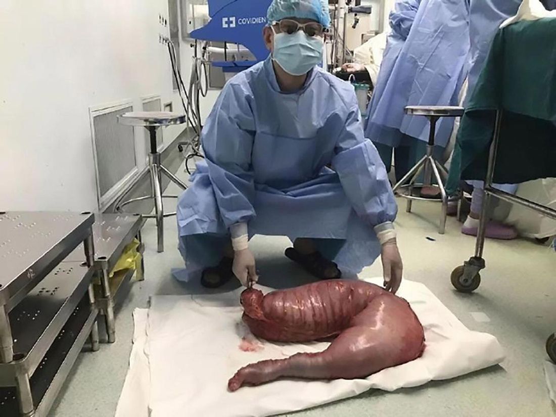 megacolon, hirschsprung disease